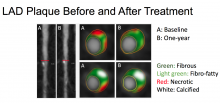 A key slide from Elnabawi's presentation, showing cardiac CT plaque evaluations, showing the impact of psoriasis medication on coronary plaques at baseline and one year of treatment. It shows a reversal of vulnerable plaque development. #SCAI, #SCAI2018 