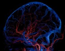 stroke treatment devices clinical trial study alabama