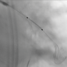 bifurcation stenting