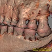 3-D reconstruction of teeth of an Egyptian mummy as seen in a CT scan.