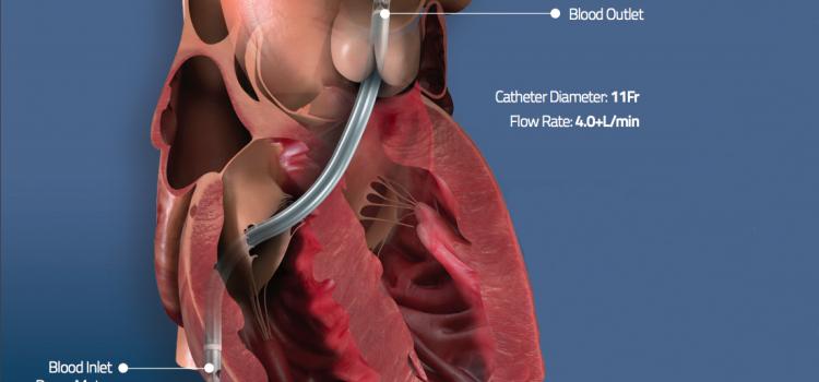 Pulmonary Embolism Daic