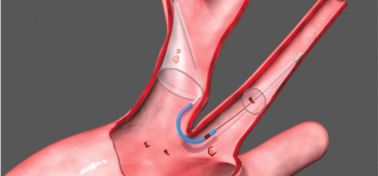 Claret's FDA-cleared Sentinel Cerebral Embolic Protection System for TAVR will expand Boston Scientific's structural heart portfolio. It collects emboli knocked loose that would otherwise lodge in the brain and potentially cause a stroke. 