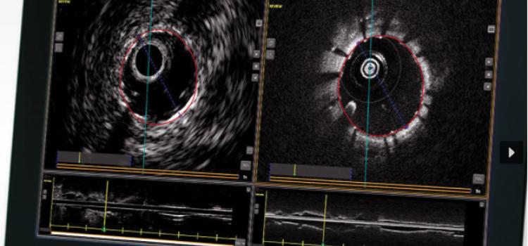 The Conavi Novasight hybrid intravascular imaging system that combines IVUS and OCT.