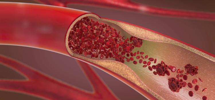 Data from the randomized control trial will advance evidence for evaluation and treatment of heart disease by studying actual disease: atherosclerosis.