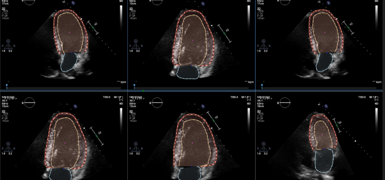 Echo:Prio , part of the complete cardiac platform named Libby, offers fast, data-driven image analysis of echocardiogram images