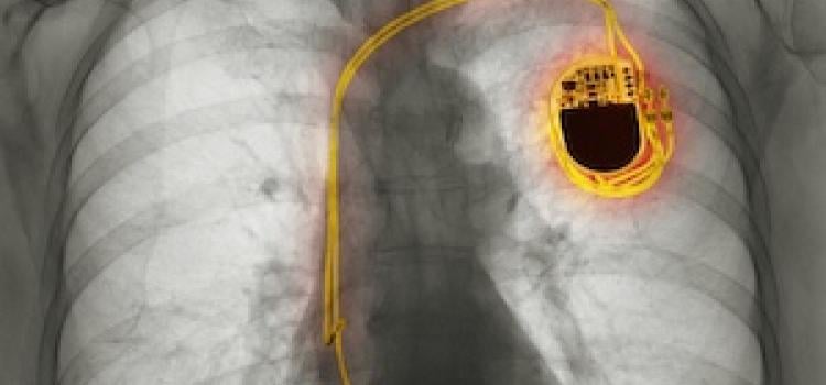 Pacemaker, Afib, ai