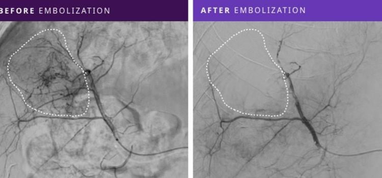 Before and after embolization images