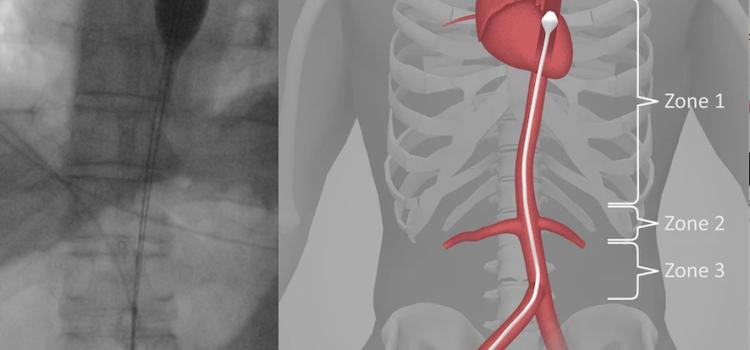 A new treatment to achieve return of spontaneous circulation (ROSC) in refractory cardiac arrest patients is the use of resuscitative endovascular balloon occlusion of the aorta (REBOA). The images show the balloon seen deployed on an angiogram and an illustration showing its placement in the aorta. 