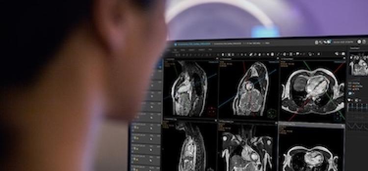 Philips, SmartHeart, cardiac MRI