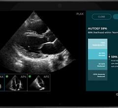 aption Health a leader in medical AI technology, has received U.S. Food and Drug Administration (FDA) 510(k) clearance for an updated version of Caption Interpretation, which uses artificial intelligence (AI) to enable clinicians to obtain quick, easy and accurate measurements of cardiac ejection fraction (EF) at the point of care.